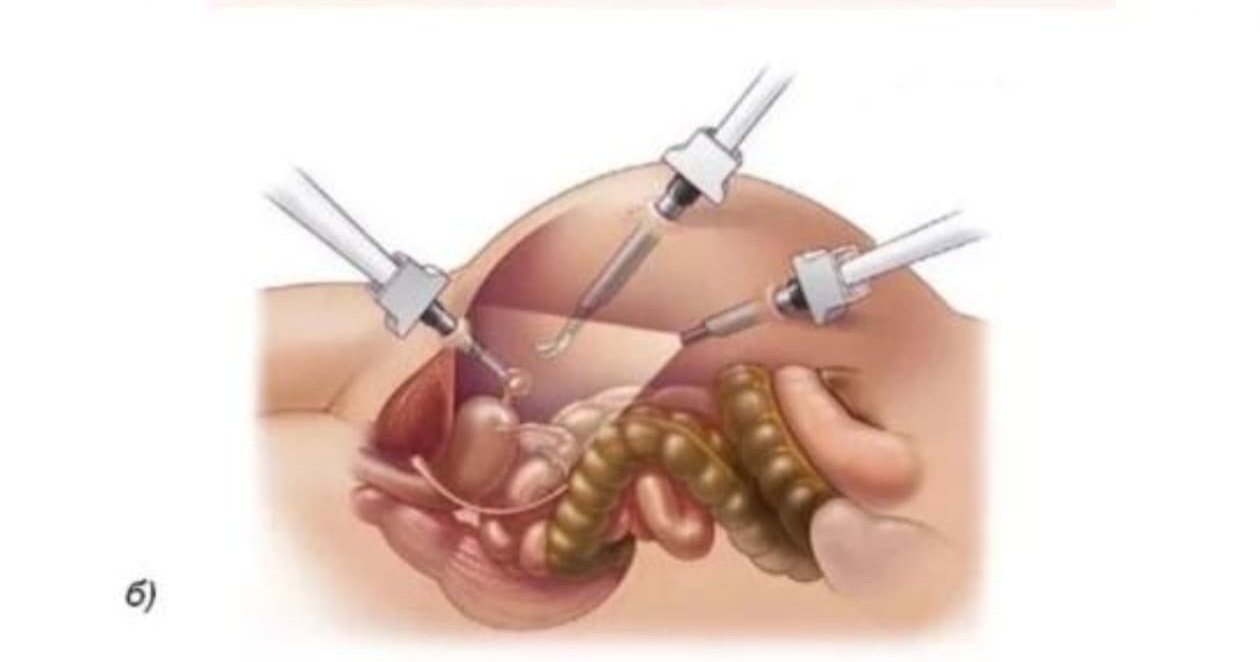 Non-descent vaginal hysterectomy