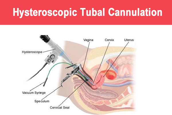 Hysteroscopic tubal cannulation