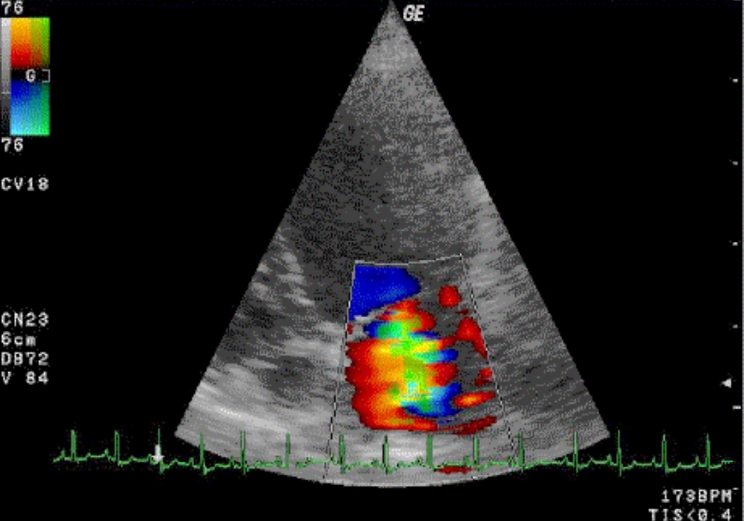 Ultrasound